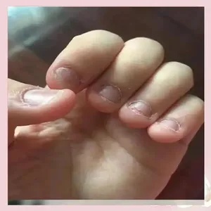 揭开啃指甲者的心理之谜:那些隐藏的秘密